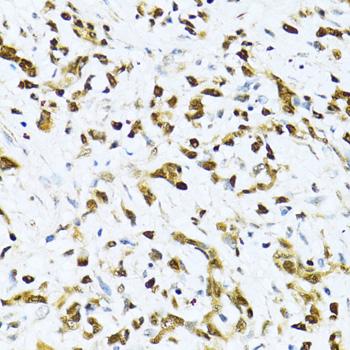 ITGB3BP Antibody - Immunohistochemistry of paraffin-embedded Human gastric cancer using ITGB3BP Polyclonal Antibody at dilution of 1:100 (40x lens).