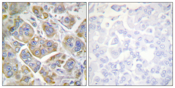 ITGB4 / Integrin Beta 4 Antibody - Immunohistochemistry analysis of paraffin-embedded human breast carcinoma tissue, using Integrin beta4 Antibody. The picture on the right is blocked with the synthesized peptide.