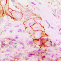 ITGB4 / Integrin Beta 4 Antibody - Immunohistochemical analysis of CD104 staining in human breast cancer formalin fixed paraffin embedded tissue section. The section was pre-treated using heat mediated antigen retrieval with sodium citrate buffer (pH 6.0). The section was then incubated with the antibody at room temperature and detected using an HRP conjugated compact polymer system. DAB was used as the chromogen. The section was then counterstained with hematoxylin and mounted with DPX.