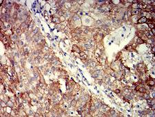 ITGB4 / Integrin Beta 4 Antibody - Immunohistochemical analysis of paraffin-embedded stomach cancer tissues using CD104 mouse mAb with DAB staining.
