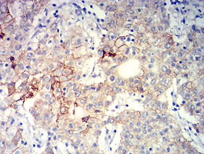 ITGB4 / Integrin Beta 4 Antibody - Immunohistochemical analysis of paraffin-embedded stomach cancer tissues using CD104 mouse mAb with DAB staining.