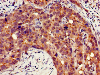 ITGB4 / Integrin Beta 4 Antibody - Immunohistochemistry of paraffin-embedded human pancreatic cancer using ITGB4 Antibody at dilution of 1:100