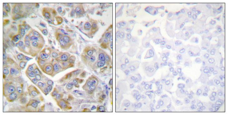 ITGB4 / Integrin Beta 4 Antibody - Peptide - + Immunohistochemistry analysis of paraffin-embedded human breast carcinoma tissue using ITGB4 (Ab-1510) antibody.