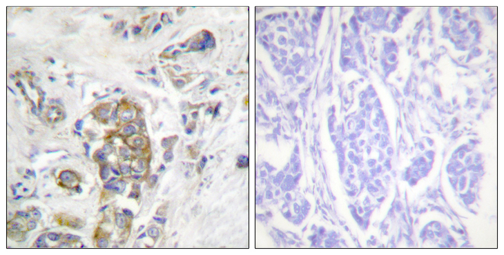 ITGB4 / Integrin Beta 4 Antibody - Immunohistochemistry analysis of paraffin-embedded human breast carcinoma, using ITGB4 (Phospho-Tyr1510) Antibody. The picture on the right is blocked with the phospho peptide.