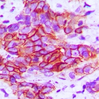 ITGB4 / Integrin Beta 4 Antibody - Immunohistochemical analysis of CD104 (pY1510) staining in human breast cancer formalin fixed paraffin embedded tissue section. The section was pre-treated using heat mediated antigen retrieval with sodium citrate buffer (pH 6.0). The section was then incubated with the antibody at room temperature and detected with HRP and DAB as chromogen. The section was then counterstained with hematoxylin and mounted with DPX.