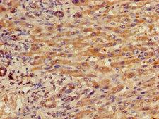 ITGB5 / Integrin Beta 5 Antibody - Immunohistochemistry of paraffin-embedded human liver cancer using ITGB5 Antibody at dilution of 1:100