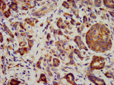 ITGB6 / Integrin Beta 6 Antibody - Immunohistochemistry image at a dilution of 1:400 and staining in paraffin-embedded human pancreatic cancer performed on a Leica BondTM system. After dewaxing and hydration, antigen retrieval was mediated by high pressure in a citrate buffer (pH 6.0) . Section was blocked with 10% normal goat serum 30min at RT. Then primary antibody (1% BSA) was incubated at 4 °C overnight. The primary is detected by a biotinylated secondary antibody and visualized using an HRP conjugated SP system.