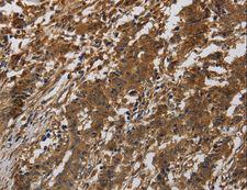 ITGB7 / Integrin Beta 7 Antibody - Immunohistochemistry of paraffin-embedded Human gastric cancer using ITGB7 Polyclonal Antibody at dilution of 1:40.