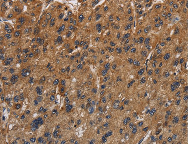 ITGB7 / Integrin Beta 7 Antibody - Immunohistochemistry of paraffin-embedded Human gastric cancer using ITGB7 Polyclonal Antibody at dilution of 1:40.