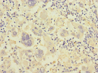 ITGB7 / Integrin Beta 7 Antibody - Immunohistochemistry of paraffin-embedded human liver cancer at dilution 1:100