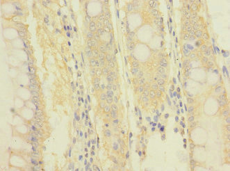 ITGB7 / Integrin Beta 7 Antibody - Immunohistochemistry of paraffin-embedded human colon cancer at dilution 1:100