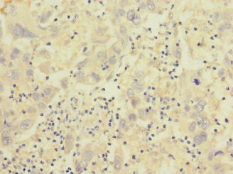 ITGB7 / Integrin Beta 7 Antibody - Immunohistochemistry of paraffin-embedded human liver cancer at dilution 1:100