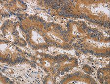 ITIH1 Antibody - Immunohistochemistry of paraffin-embedded Human thyroid cancer using ITIH1 Polyclonal Antibody at dilution of 1:30.