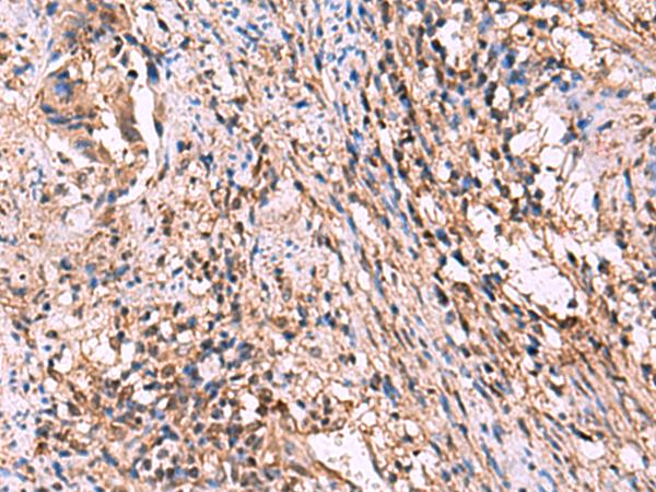 ITIH4 Antibody - Immunohistochemistry of paraffin-embedded Human cervical cancer tissue  using ITIH4 Polyclonal Antibody at dilution of 1:30(×200)
