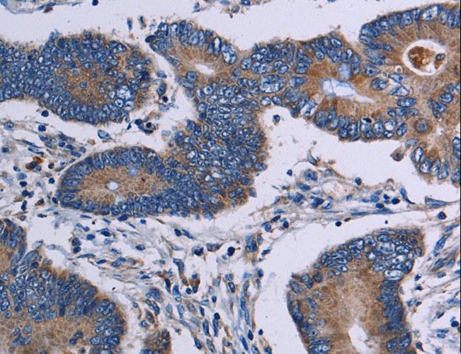 ITK / EMT Antibody - Immunohistochemistry of paraffin-embedded Human colon cancer using ITK Polyclonal Antibody at dilution of 1:50.