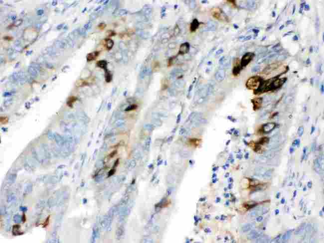 ITLN1 / Omentin Antibody - ITLN1 was detected in paraffin-embedded sections of human intestinal cancer tissues using rabbit anti- ITLN1 Antigen Affinity purified polyclonal antibody