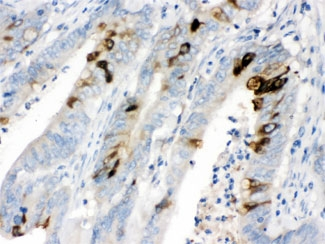 ITLN1 / Omentin Antibody - IHC testing of FFPE human intestinal cancer tissue with ITLN1 antibody at 1ug/ml. HIER: steam in pH6 citrate buffer and allow to cool prior to staining.