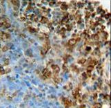 ITPA Antibody - ITPA Antibody immunohistochemistry of formalin-fixed and paraffin-embedded human lung carcinoma followed by peroxidase-conjugated secondary antibody and DAB staining.