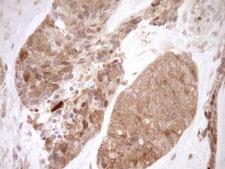 ITPK1 Antibody - Immunohistochemical staining of paraffin-embedded Adenocarcinoma of Human endometrium tissue using anti-ITPK1 mouse monoclonal antibody. (Heat-induced epitope retrieval by 1mM EDTA in 10mM Tris buffer. (pH8.5) at 120°C for 3 min. (1:150)