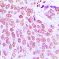 ITPKC Antibody - Immunohistochemical analysis of ITPKC staining in human breast cancer formalin fixed paraffin embedded tissue section. The section was pre-treated using heat mediated antigen retrieval with sodium citrate buffer (pH 6.0). The section was then incubated with the antibody at room temperature and detected using an HRP conjugated compact polymer system. DAB was used as the chromogen. The section was then counterstained with hematoxylin and mounted with DPX.