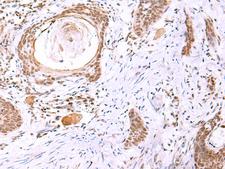 ITPKC Antibody - Immunohistochemistry of paraffin-embedded Human esophagus cancer tissue  using ITPKC Polyclonal Antibody at dilution of 1:30(×200)