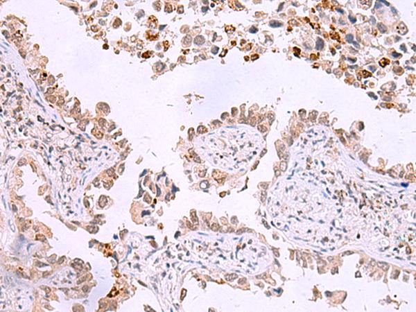 ITPKC Antibody - Immunohistochemistry of paraffin-embedded Human lung cancer tissue  using ITPKC Polyclonal Antibody at dilution of 1:30(×200)