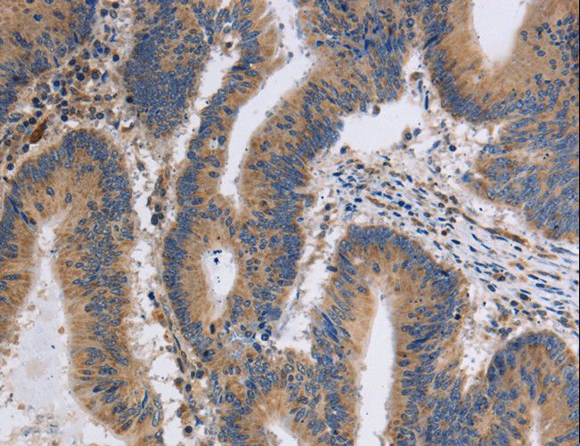 ITPR1 / IP3 Receptor Type 1 Antibody - Immunohistochemistry of paraffin-embedded Human thyroid cancer using ITPR1 Polyclonal Antibody at dilution of 1:40.