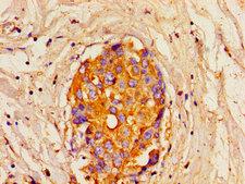 ITPR1 / IP3 Receptor Type 1 Antibody - Immunohistochemistry image of paraffin-embedded human breast cancer at a dilution of 1:100