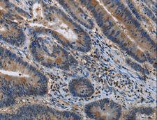 ITPR2 / IP3 Receptor Type 2 Antibody - Immunohistochemistry of paraffin-embedded Human colon cancer using ITPR2 Polyclonal Antibody at dilution of 1:40.