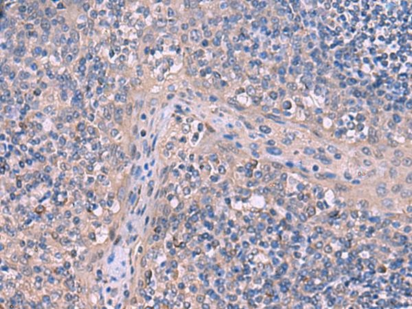 ITPR2 / IP3 Receptor Type 2 Antibody - Immunohistochemistry of paraffin-embedded Human tonsil tissue  using ITPR2 Polyclonal Antibody at dilution of 1:65(×200)