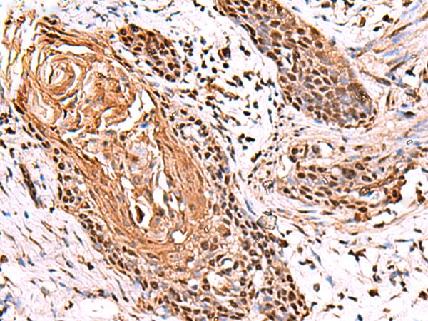 ITPR2 / IP3 Receptor Type 2 Antibody - Immunohistochemistry of paraffin-embedded Human esophagus cancer tissue  using ITPR2 Polyclonal Antibody at dilution of 1:65(×200)