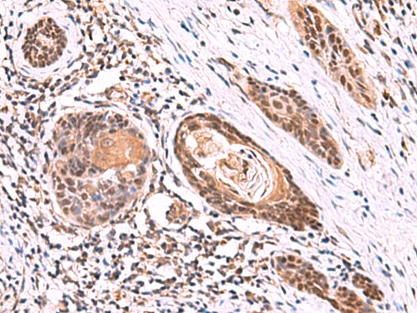 ITPR2 / IP3 Receptor Type 2 Antibody - Immunohistochemistry of paraffin-embedded Human esophagus cancer tissue  using ITPR2 Polyclonal Antibody at dilution of 1:60(×200)