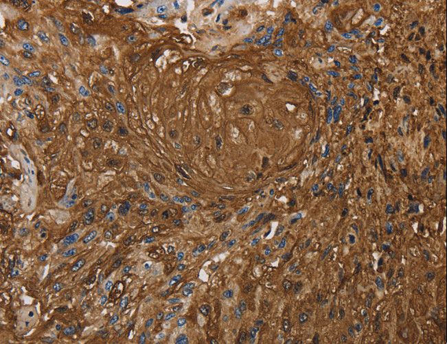 ITPR3 Antibody - Immunohistochemistry of paraffin-embedded Human esophagus cancer using ITPR3 Polyclonal Antibody at dilution of 1:30.