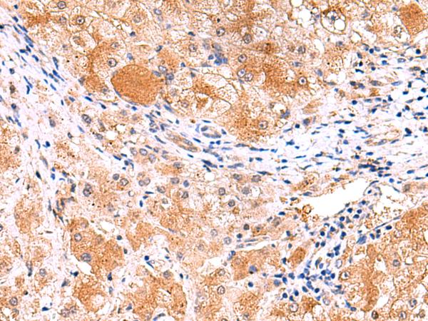 ITSN2 Antibody - Immunohistochemistry of paraffin-embedded Human liver cancer tissue  using ITSN2 Polyclonal Antibody at dilution of 1:40(×200)