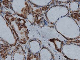 IVD Antibody - Immunohistochemical staining of paraffin-embedded Carcinoma of Human thyroid tissue using anti-IVD mouse monoclonal antibody  at 1:150 dilution.