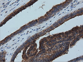 IVD Antibody - Immunohistochemical staining of paraffin-embedded Adenocarcinoma of Human endometrium tissue using anti-IVD mouse monoclonal antibody  at 1:150 dilution.