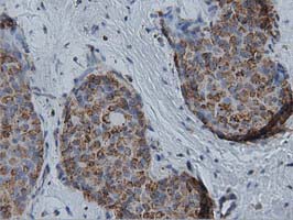 IVD Antibody - Immunohistochemical staining of paraffin-embedded Adenocarcinoma of Human breast tissue using anti-IVD mouse monoclonal antibody  at 1:150 dilution.