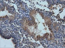 IVD Antibody - Immunohistochemical staining of paraffin-embedded Carcinoma of Human prostate tissue using anti-IVD mouse monoclonal antibody  at 1:150 dilution.