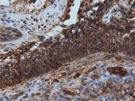 IVD Antibody - Immunohistochemical staining of paraffin-embedded Carcinoma of Human bladder tissue using anti-IVD mouse monoclonal antibody  at 1:150 dilution.