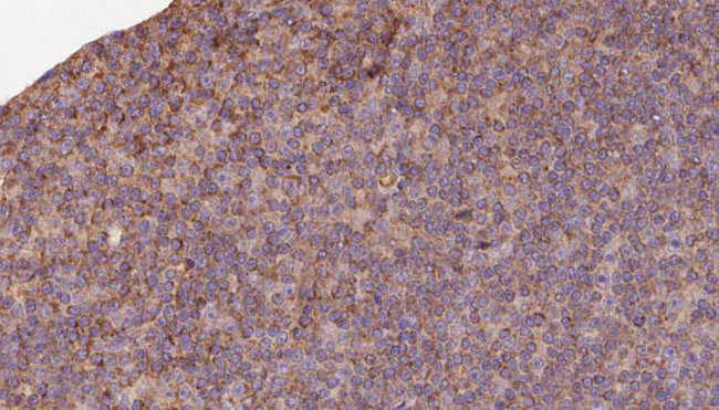 IVD Antibody - 1:100 staining human lymph carcinoma tissue by IHC-P. The sample was formaldehyde fixed and a heat mediated antigen retrieval step in citrate buffer was performed. The sample was then blocked and incubated with the antibody for 1.5 hours at 22°C. An HRP conjugated goat anti-rabbit antibody was used as the secondary.