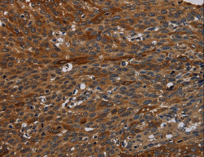 IVL / Involucrin Antibody - Immunohistochemistry of paraffin-embedded Human thyroid cancer using IVL Polyclonal Antibody at dilution of 1:50.