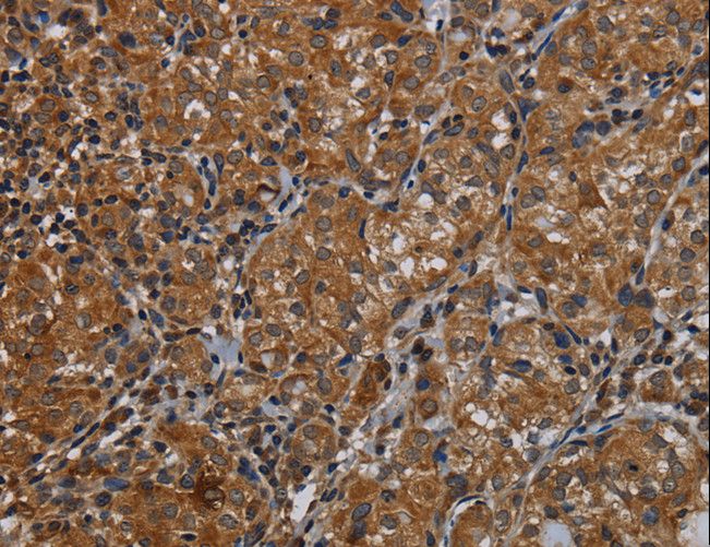 IVL / Involucrin Antibody - Immunohistochemistry of paraffin-embedded Human thyroid cancer using IVL Polyclonal Antibody at dilution of 1:50.