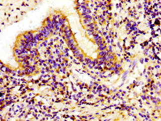 IVL / Involucrin Antibody - Immunohistochemistry image of paraffin-embedded human lung cancer at a dilution of 1:100