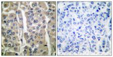 IVL / Involucrin Antibody - Peptide - + Immunohistochemical analysis of paraffin-embedded human breast carcinoma tissue using Involucrin antibody.