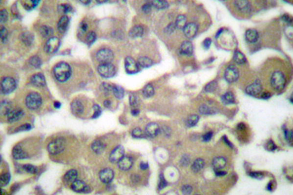 IVL / Involucrin Antibody - IHC of Involucrin (P568) pAb in paraffin-embedded human breast carcinoma tissue.