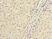 IWS1 Antibody - Immunohistochemistry of paraffin-embedded human liver cancer at dilution 1:100