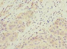 JADE1 / PHF17 Antibody - Immunohistochemistry of paraffin-embedded human liver cancer at dilution 1:100