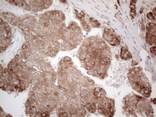 JAG1 / Jagged 1 Antibody - Immunohistochemical staining of paraffin-embedded Carcinoma of Human liver tissue using anti-JAG1 mouse monoclonal antibody. (Heat-induced epitope retrieval by 1mM EDTA in 10mM Tris buffer. (pH8.5) at 120°C for 3 min. (1:150)
