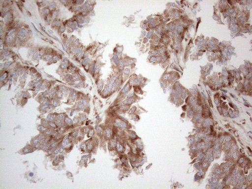 JAG1 / Jagged 1 Antibody - Immunohistochemical staining of paraffin-embedded Adenocarcinoma of Human ovary tissue using anti-JAG1 mouse monoclonal antibody. (Heat-induced epitope retrieval by 1mM EDTA in 10mM Tris buffer. (pH8.5) at 120°C for 3 min. (1:150)