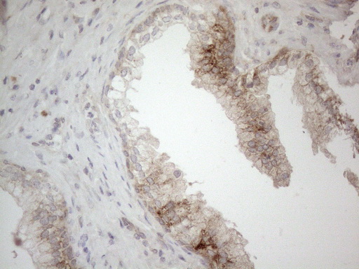 JAG1 / Jagged 1 Antibody - Immunohistochemical staining of paraffin-embedded Carcinoma of Human prostate tissue using anti-JAG1 mouse monoclonal antibody. (Heat-induced epitope retrieval by 1mM EDTA in 10mM Tris buffer. (pH8.5) at 120°C for 3 min. (1:150)